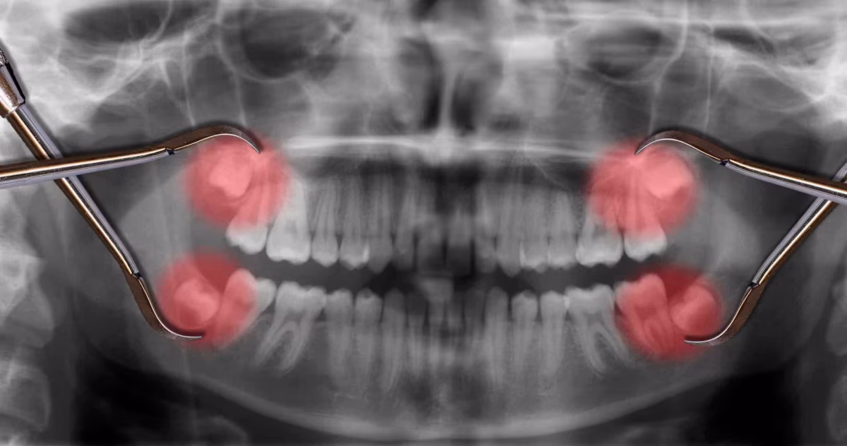 Display four wisdom teeth over x ray