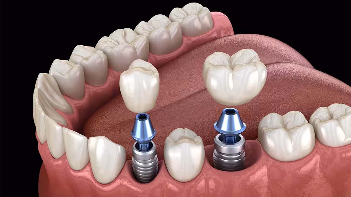 IMplants