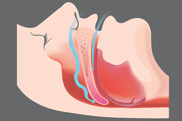 Sleep apnea Photo